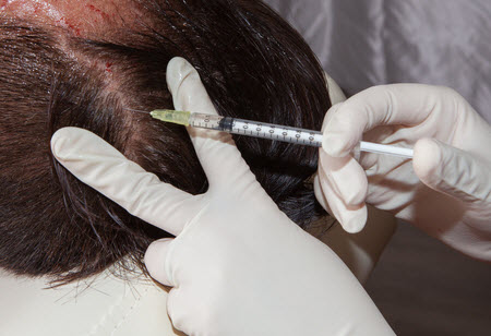 PRP - Platelet Plasma Therapy | Hair Loss Clinic in Glasgow