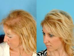 female hair thinning 2