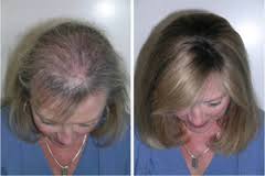 Menopause Hair Loss | Female Hair Loss Clinic Glasgow
