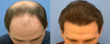 SYNTHETIC HAIR TRANSPLANT: KNOW THE SIGNIFICANCE OF SYNTHETIC IMPLANTATION